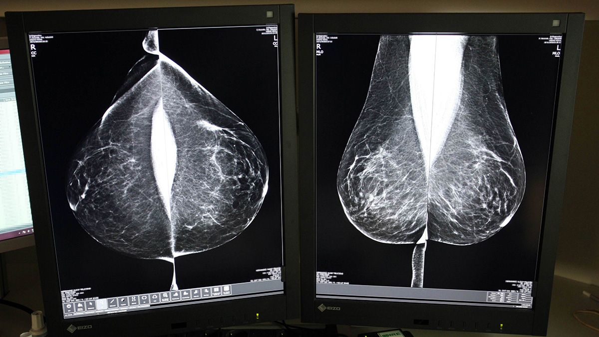 Estudio una mamografía digital, en el servicio de mamografías del Hospital Río Hortega de Valladolid. | ICAL
