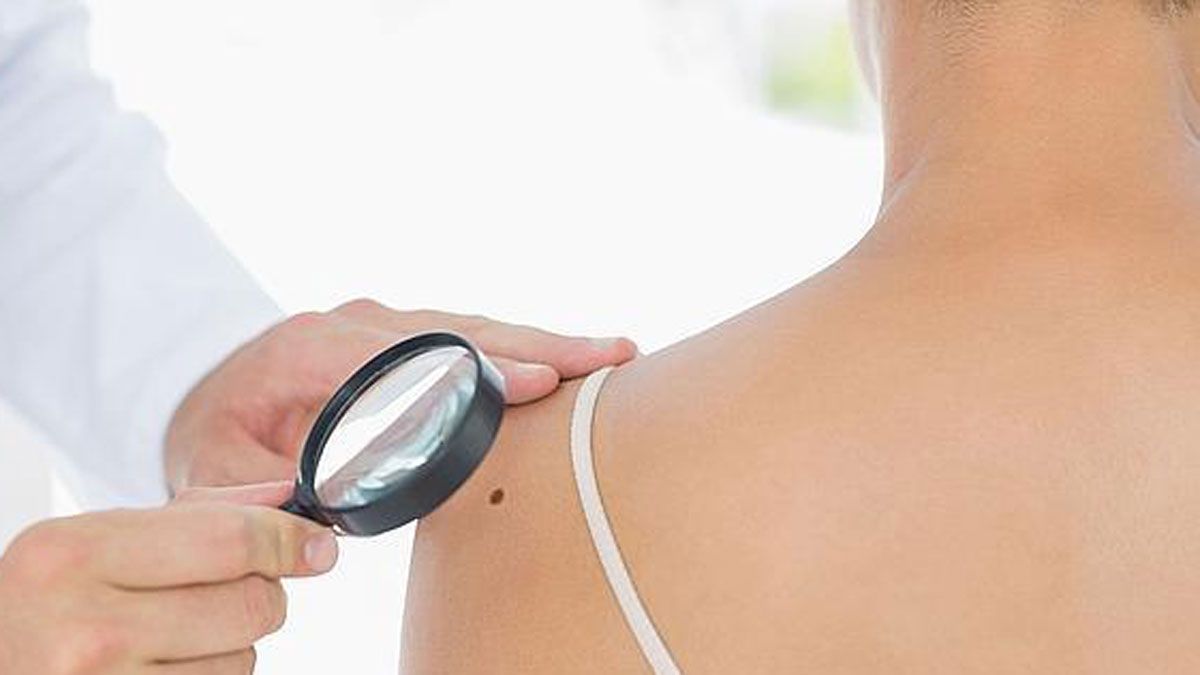 La prevención y rápido tratamiento del cáncer de piel es fundamental.