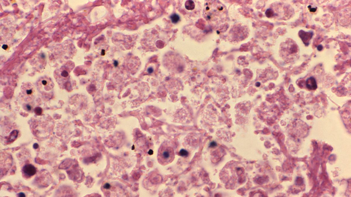 lung_tissue_during_legionellosis.jpg