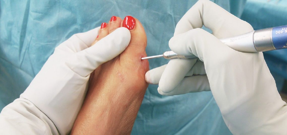 La cirugía percutánea del pie, también conocida como cirugía MIS, es una técnica quirúrgica novedosa.