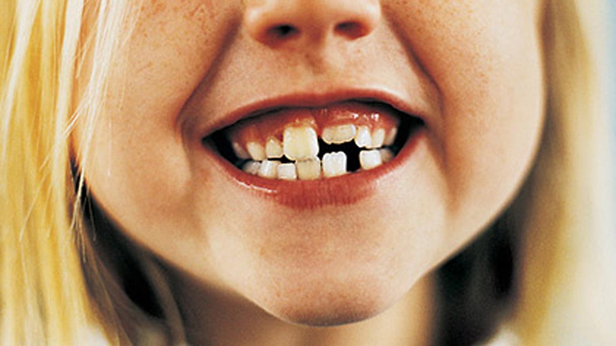 Unos 95.000 niños menores de 12 años de Castilla y León ya tienen caries en sus dientes de leche.