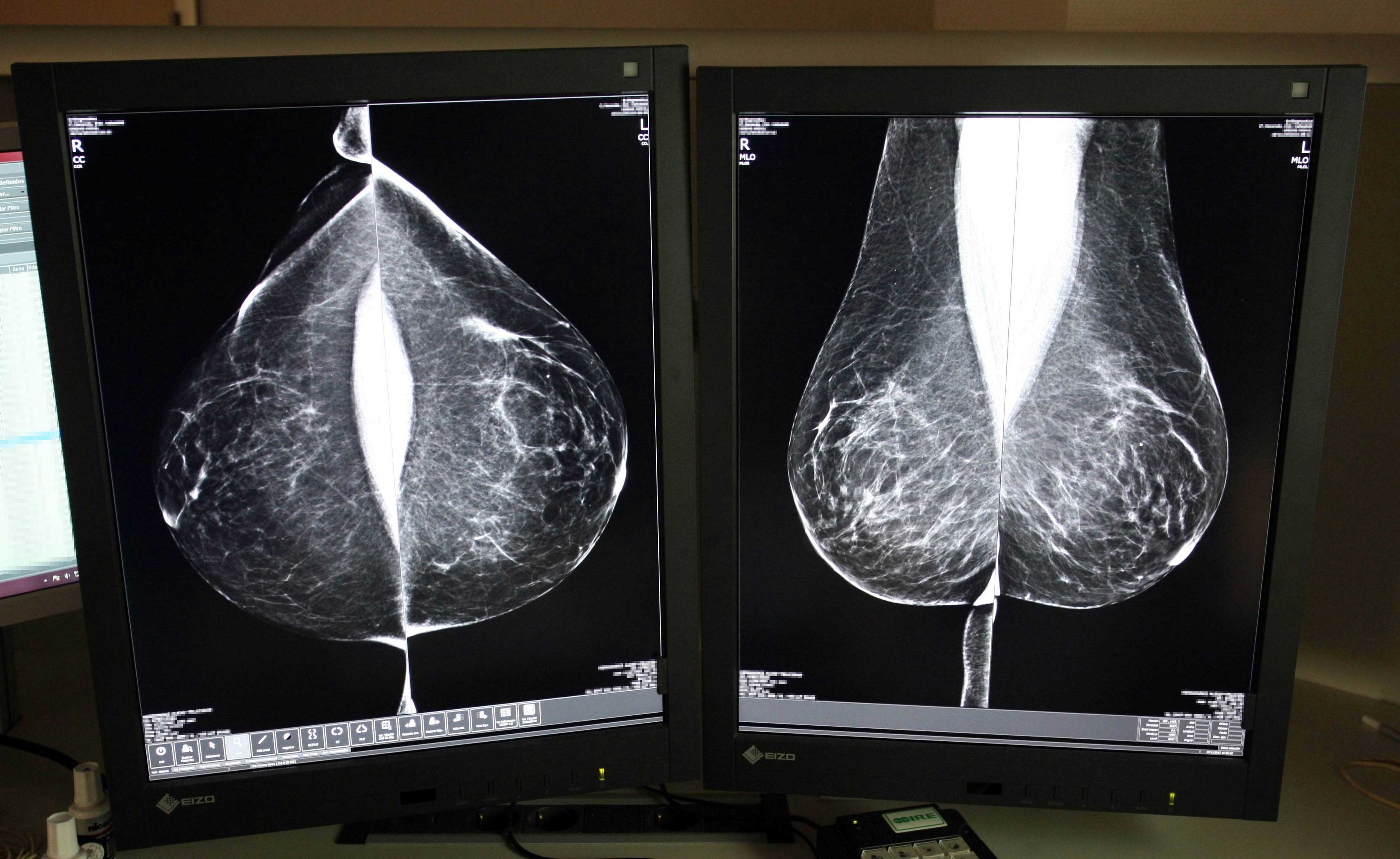 Imagen del estudio de una mamografía en un hospital de Valladolid. | ICAL
