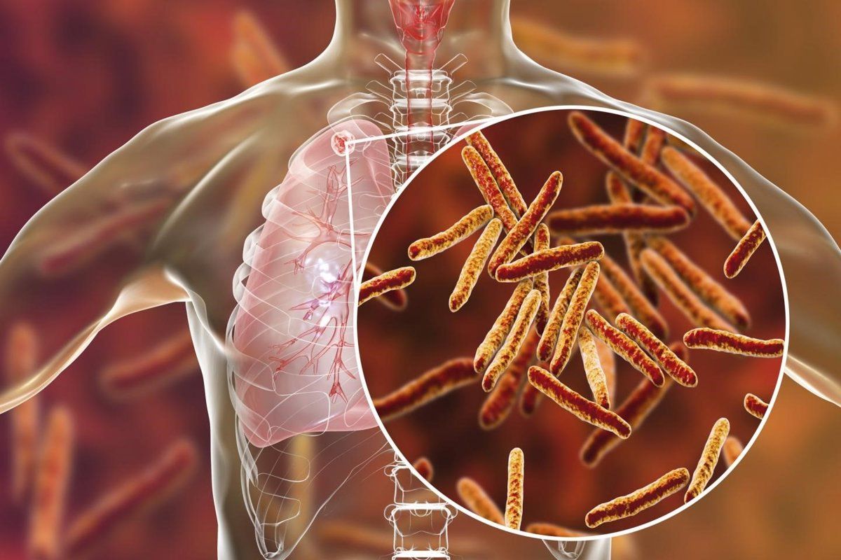 La tuberculosis afecta al sistema respiratorio. | EUROPA PRESS