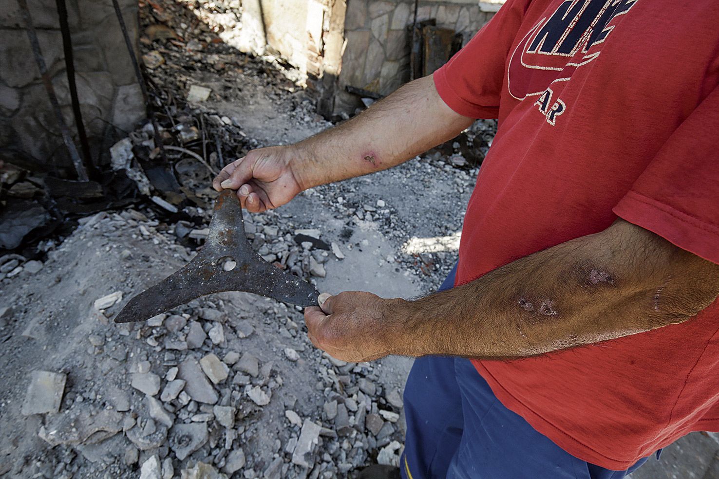 Manolo, con sus brazos con quemaduras por intentar salvar las llamas de su casa. | FERNANDO OTERO