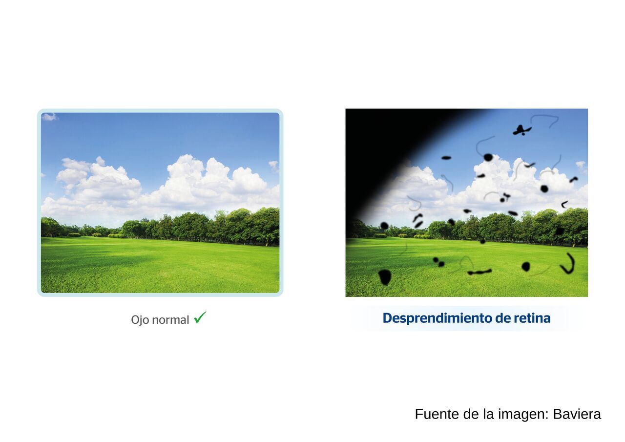  Desprendimiento de retina
