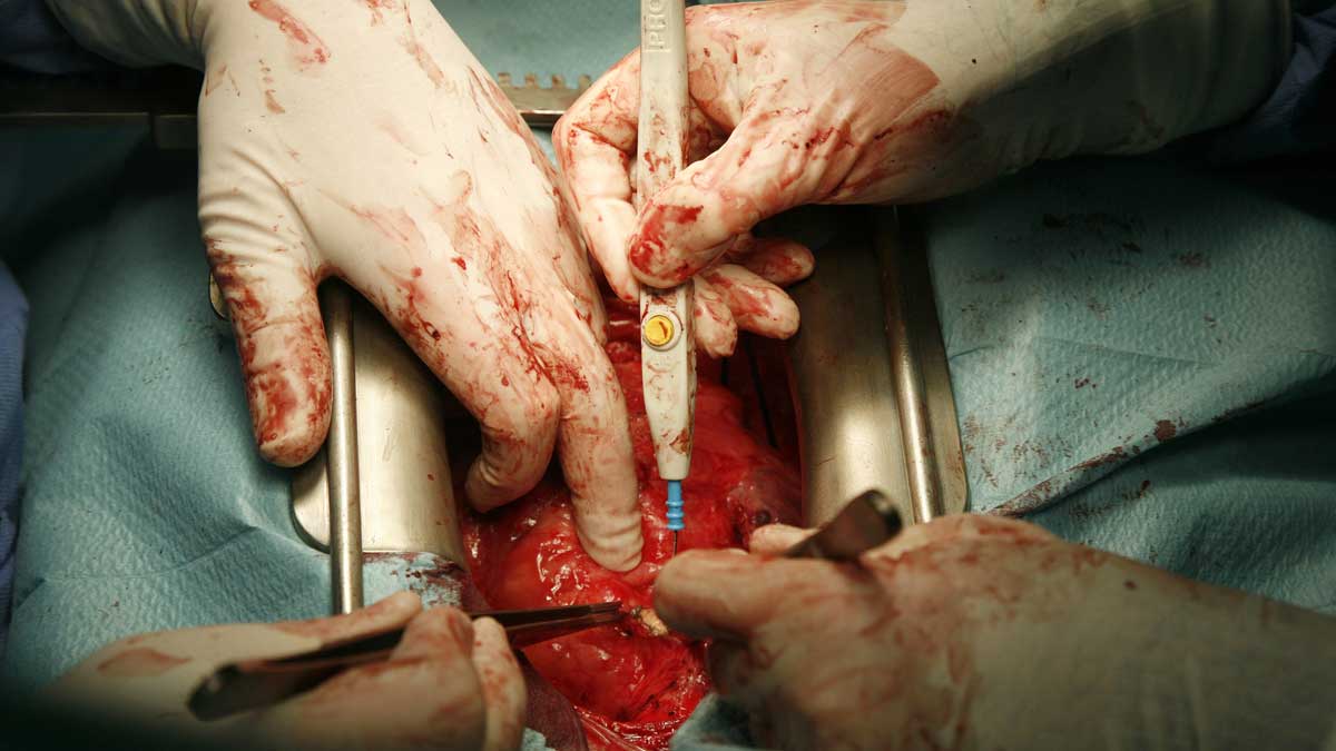 Una operación de trasplante de órganos en la comunidad. | ICAL