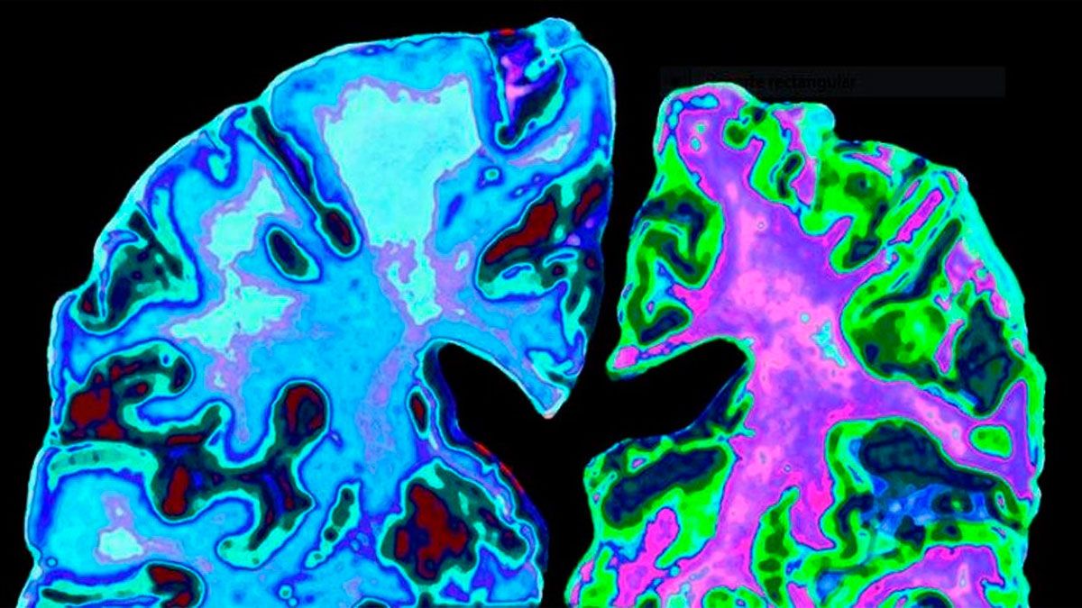 Imagen de archivo de un cerebro con Alzhéimer. | ABC